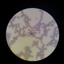 Krvni razmaz na mikroskopu- babezija