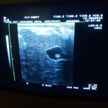 Ultrazvuk kamen u žučnoj kesi