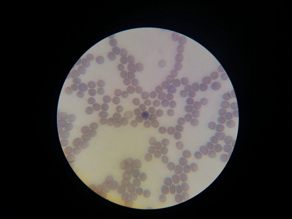 Krvni razmaz na mikroskopu- babezija